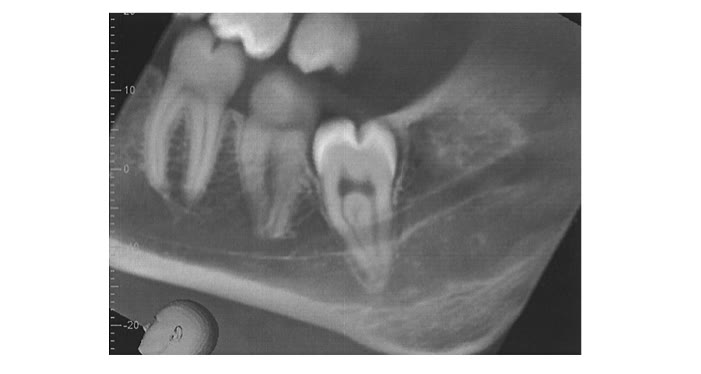 Secțiune de tomografie dentară cu un molar de minte inferior inclus, alături de molarul vecin și de canalul mandibular