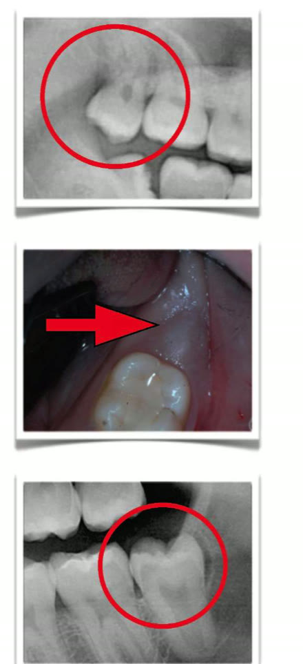 Colaj cu trei imagini: două radiografii în care molarul de minte este marcat cu un cerc roșu și o fotografie clinică în care o săgeată indică țesutul gingival ce acoperă măseaua