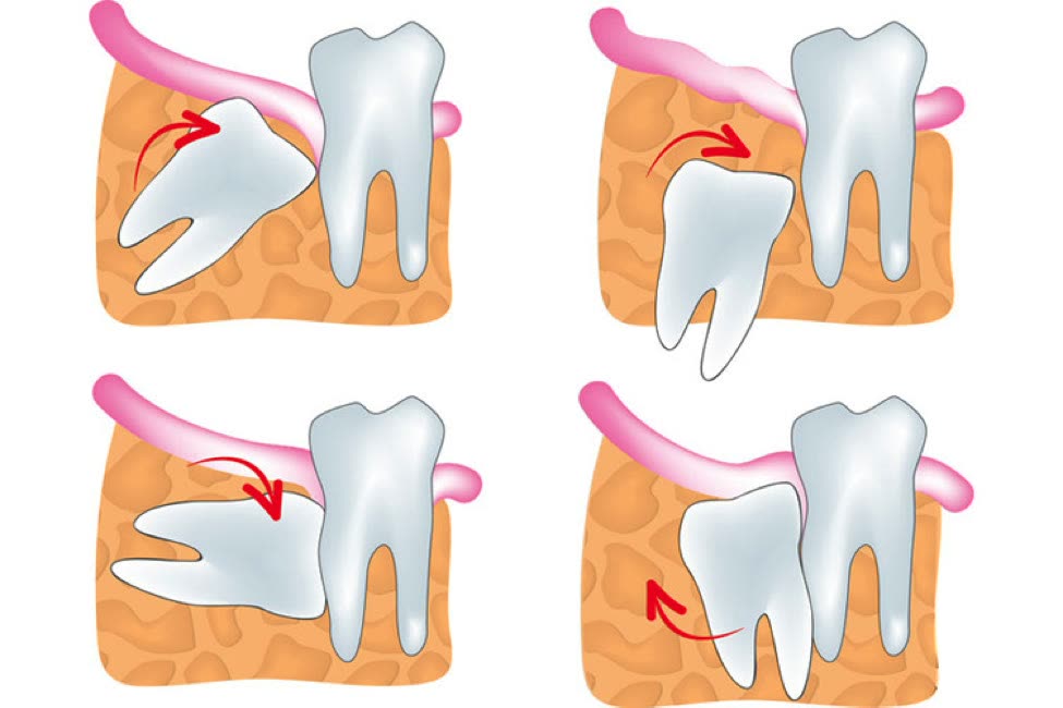 Ilustrație cu patru variante de incluzie a molarului de minte în osul mandibular, în raport cu molarul vecin: înclinat în față, vertical, orizontal și înclinat în spate