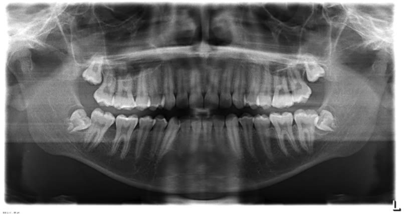 Radiografie panoramică digitală a ambelor maxilare, în care se văd toți dinții și cei patru molari de minte