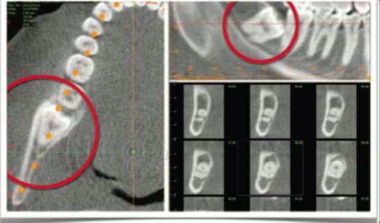 Secțiuni din tomografia dentară cu fascicul conic, cu molarul de minte inferior marcat cu un cerc roșu