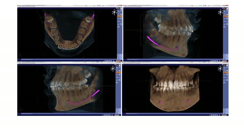 Patru reconstrucții tridimensionale din tomografia dentară, cu traiectul canalului mandibular marcat pe fiecare imagine
