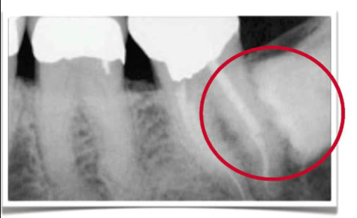 Radiografie retroalveolară pe care molarul de minte apare doar parțial, în zona marcată cu roșu