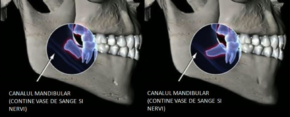 Reconstrucție 3D a mandibulei, cu detaliu asupra molarului de minte inclus și a canalului mandibular care conține vase de sânge și nervi