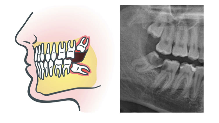 Schemă a profilului feței cu molarii de minte incluși marcați, alături de radiografia panoramică a aceleiași zone