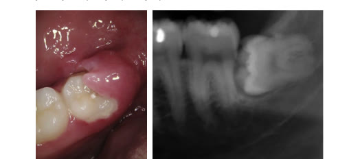 Fotografie clinică a gingiei inflamate în zona molarului de minte, alături de radiografia aceleiași zone