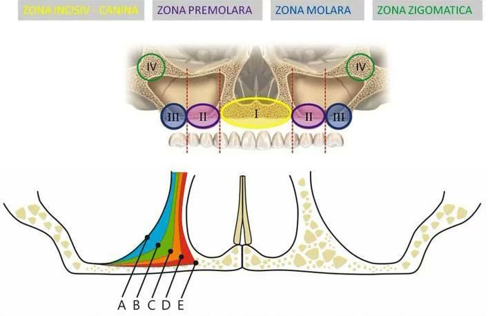 Schemă cu zonele de os ale maxilarului superior — incisiv-canină (I), premolară (II), molară (III) și zigomatică (IV) — și schemă cu gradele de pneumatizare a sinusului maxilar, notate A–E