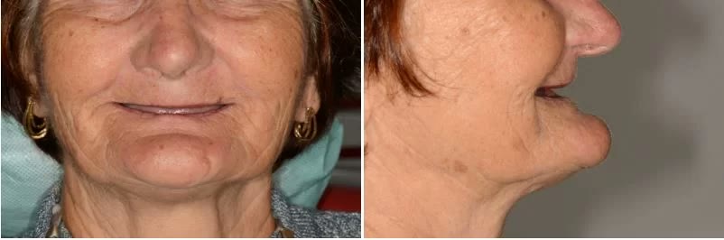 Fotografii diagnostice din față și din profil ale unei paciente cu maxilar sever atrofiat: etajul inferior al feței micșorat și ridat