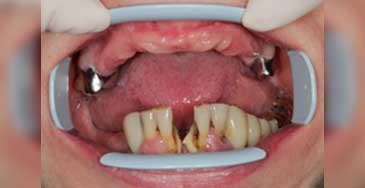 Imagine intraorală înainte de tratament: maxilar superior fără dinți, cu creastă osoasă mult resorbită