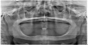 Radiografie panoramică digitală a unui maxilar superior total edentat, cu atrofie osoasă avansată