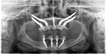 Radiografie panoramică după tratament: patru implanturi zigomatice la maxilar și implanturi convenționale la mandibulă