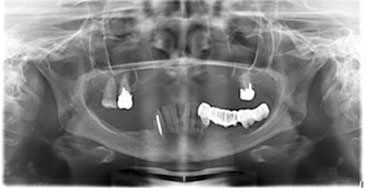 Radiografie panoramică înainte de tratament, cu maxilarul superior aproape lipsit de os și sinusurile mărite
