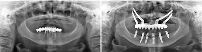 Radiografii panoramice comparate: înainte de tratament și după inserarea implanturilor zigomatice ancorate în oasele pomeților