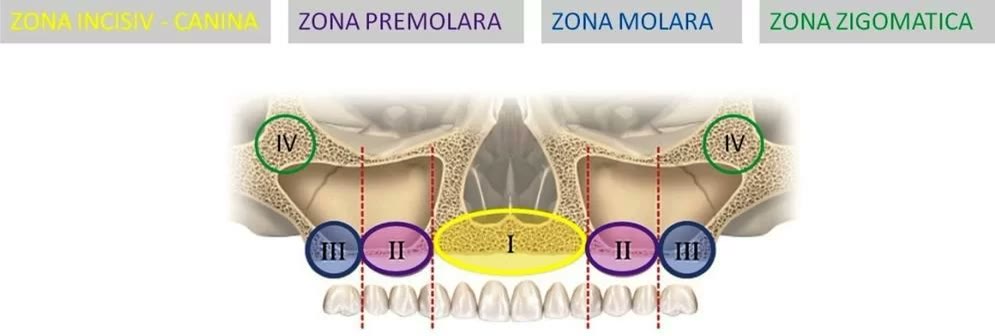 Harta zonelor de os la maxilarul superior: zona incisiv-canină, zona premolară, zona molară și zona zigomatică, marcate pe secțiune anatomică