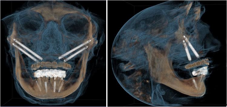 Reconstrucție 3D din tomografia întregului masiv facial, din față și din profil, cu implanturile zigomatice ancorate în pomeți