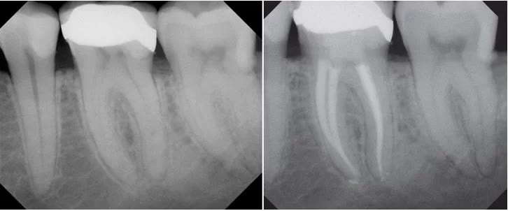 Radiografii dentare înainte și după tratamentul de canal: canalele radiculare ale molarului, obturate pe toată lungimea lor