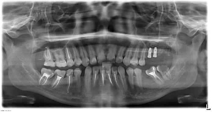 Radiografie panoramică digitală în care se văd canalele radiculare obturate ale mai multor dinți tratați endodontic