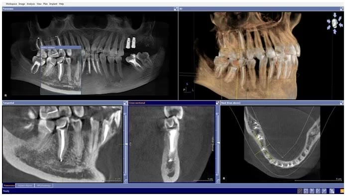 Tomografie dentară afișată în programul de planificare: secțiuni panoramice, transversale și reconstrucție 3D a maxilarelor