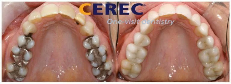Arcadă superioară înainte și după înlocuirea obturațiilor de amalgam cu restaurări CEREC din ceramică integrală