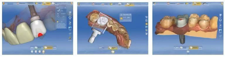 Capturi din software-ul CAD cu proiectarea unui bont protetic și a unei coroane pe implant, pe modelul 3D al arcadei