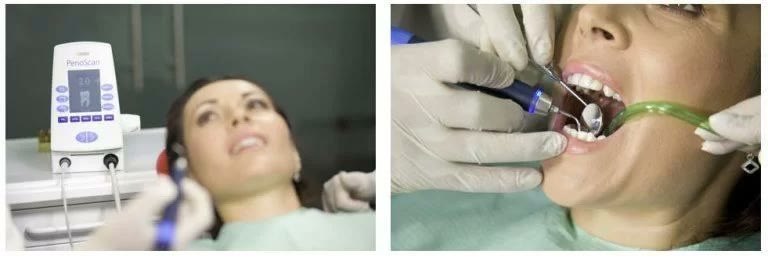 Dispozitiv de detectare a tartrului subgingival și igienizarea profesională a dinților unei paciente