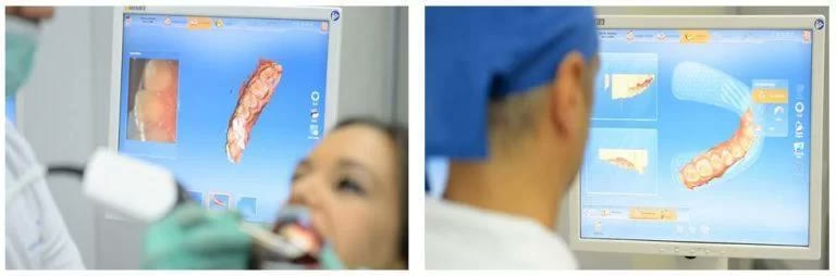 Amprentarea digitală intraorală cu camera video CEREC și modelul 3D al arcadei afișat pe monitor