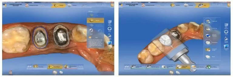 Proiectarea restaurării în software-ul CAD: conturul incrustației trasat pe modelul 3D al dintelui preparat