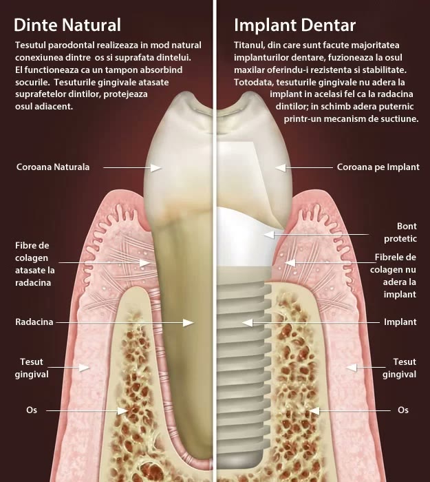 Schemă comparativă între dintele natural și implantul dentar: coroană, bont protetic, fibre de colagen, țesut gingival și os