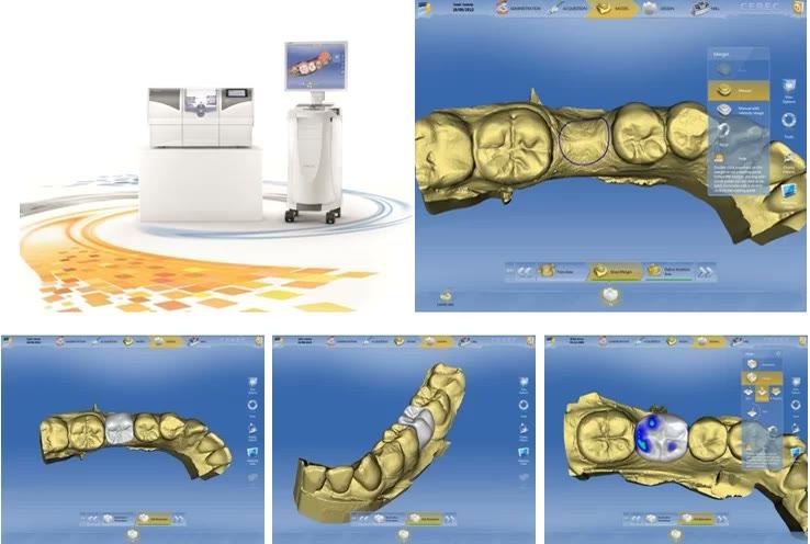 Unitatea CEREC și ecrane cu proiectarea digitală a coroanei dentare pe modelul 3D al arcadei