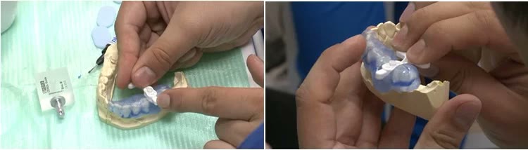 Realizarea șablonului radiologic din material termoplastic pe modelul de gips, cu corpul de scanare montat