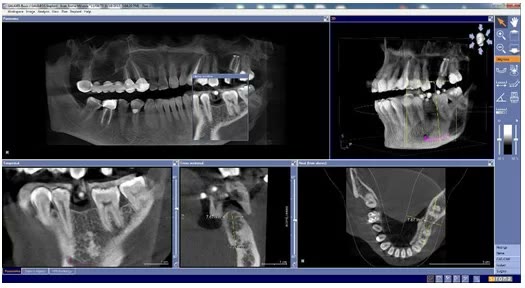 Interfața programului de diagnostic radiologic, cu secțiuni panoramice, transversale și axiale ale mandibulei