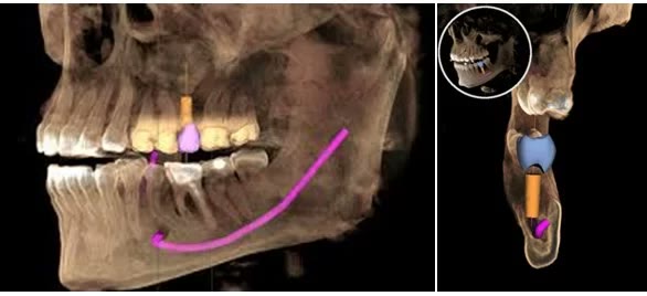 Reconstrucție 3D a maxilarelor cu traseul nervului mandibular marcat și implantul planificat virtual