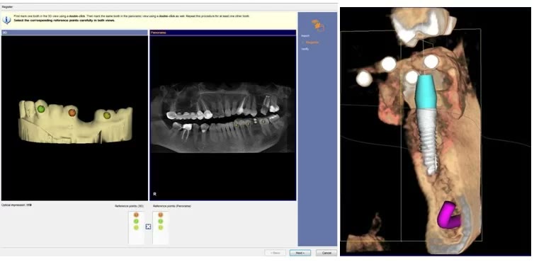 Suprapunerea amprentei optice cu tomografia dentară și poziția virtuală a implantului în osul maxilar
