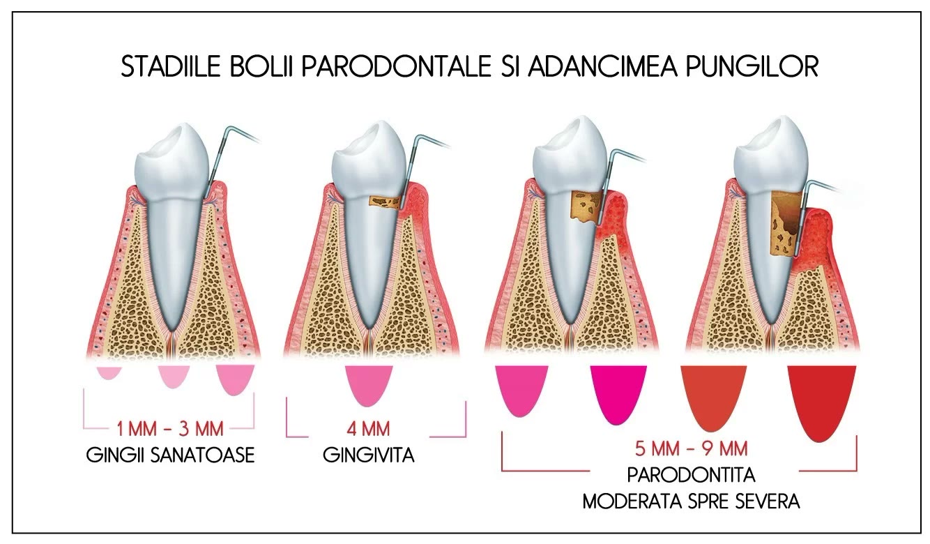 Schemă cu stadiile bolii parodontale și adâncimea pungilor: gingii sănătoase 1–3 mm, gingivită 4 mm, parodontită moderată spre severă 5–9 mm