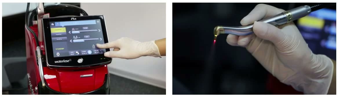 Ecranul unității laser Waterlase iPlus, cu setările de tăiere, și piesa de mână a laserului, cu fasciculul de ghidaj vizibil