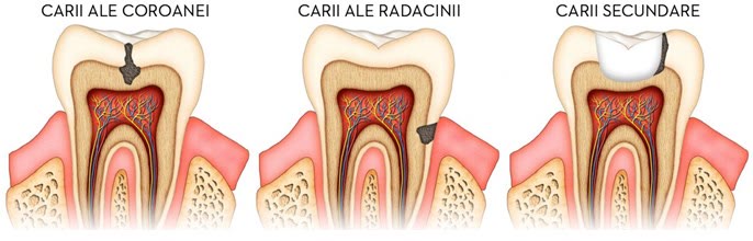 Schemă în secțiune cu tipurile de carii: carii ale coroanei, carii ale rădăcinii și carii secundare în jurul unei coroane dentare
