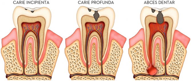 Schemă în secțiune cu evoluția cariei: carie incipientă în smalț, carie profundă până la nerv și abces dentar la vârful rădăcinii