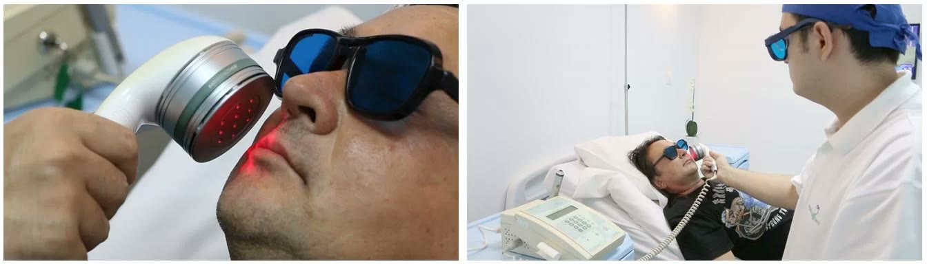 Aplicație de laser terapeutic (biostimulare) în zona feței unui pacient echipat cu ochelari de protecție și ședință de fizioterapie laser în clinică