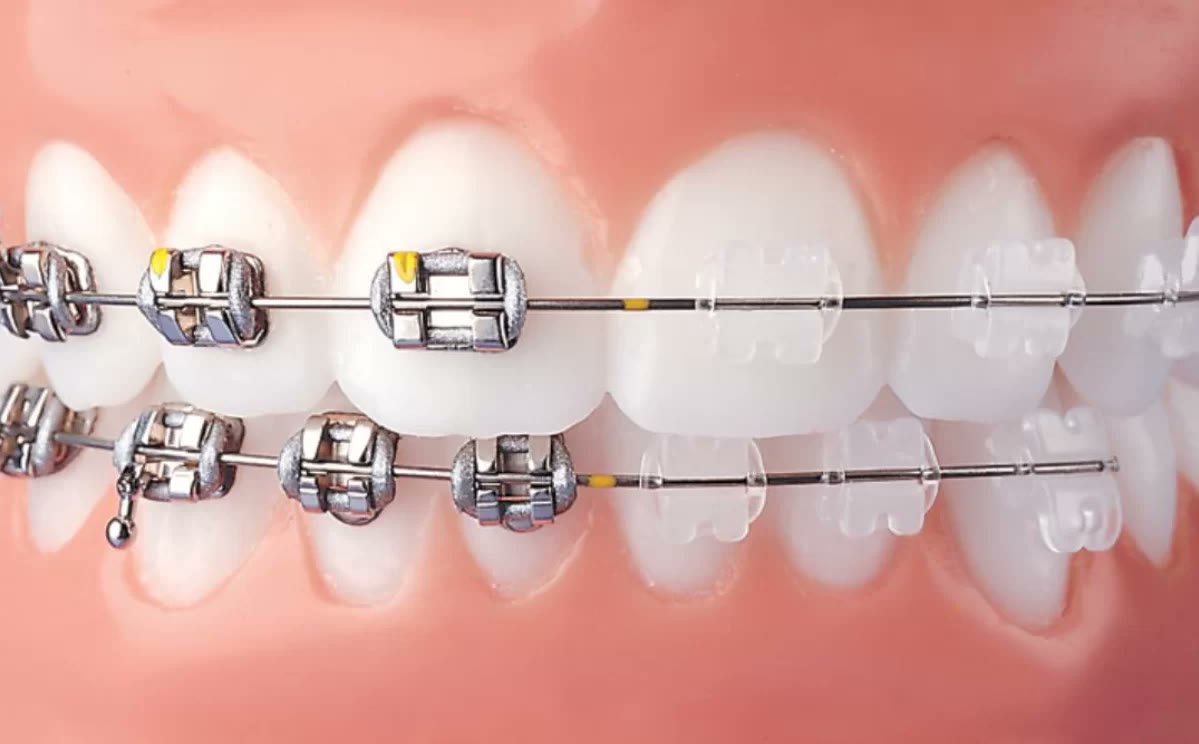 Comparație pe arcadă între brackets ortodontici metalici și brackets transparenți