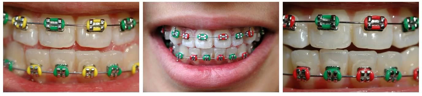 Detalii cu aparat ortodontic fix la copil: brackets metalici cu elastice colorate, verzi, galbene și roșii, montați pe ambele arcade