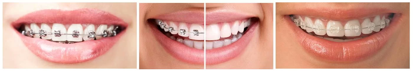Trei zâmbete cu aparat ortodontic fix: brackets metalici, comparație între arcada cu aparat și arcada aliniată după tratament și brackets transparenți