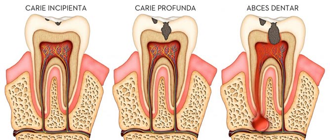 Secțiuni ilustrate prin dinte care compară caria incipientă, caria profundă și abcesul dentar
