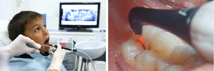 Băiat tratat pe scaunul stomatologic lângă radiografia panoramică și detaliu cu fasciculul laser aplicat pe molari