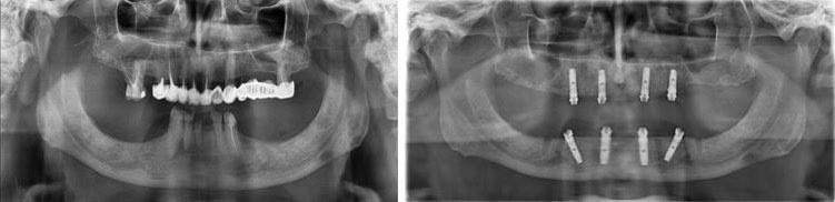 Radiografie panoramică digitală realizată în clinică, folosită pentru evaluarea maxilarelor