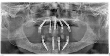 Radiografie panoramică după tratament, cu implanturile inserate și lucrările fixe pe ambele arcade