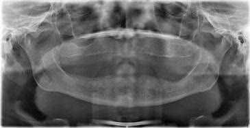 Radiografie panoramică inițială: maxilare fără dinți, cu atrofie osoasă în zonele posterioare