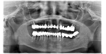Radiografie panoramică inițială: dinți restanți cu lucrări vechi și pierdere osoasă avansată