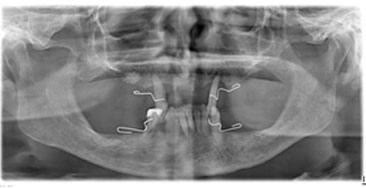 Radiografie panoramică înainte de tratament, cu dinți restanți și pierdere osoasă