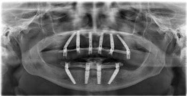 Radiografie panoramică după tratament: 6 implanturi la maxilar și 4 la mandibulă, cu lucrări fixe înșurubate