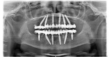 Radiografie panoramică după tratament: câte 6 implanturi pe fiecare arcadă, solidarizate de lucrările fixe
